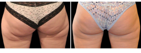 thigh fat reduction before and after 