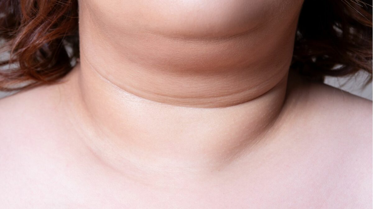 Coolsculpting for double chin