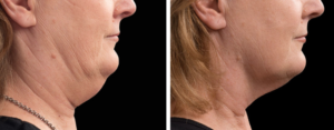 Coolsculpting for double chin