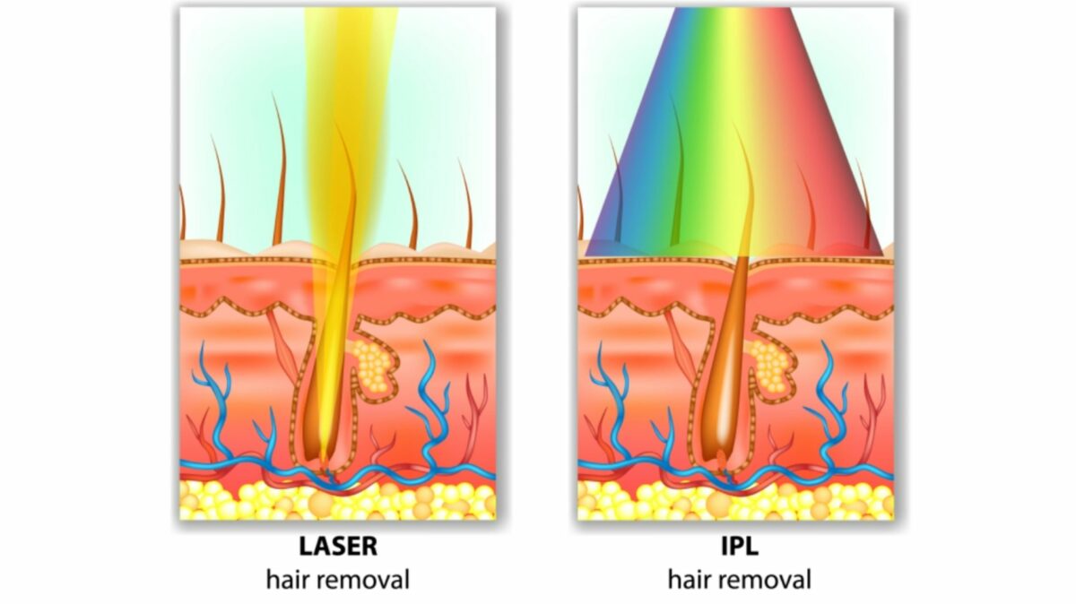 IPL home devices vs laser hair removal