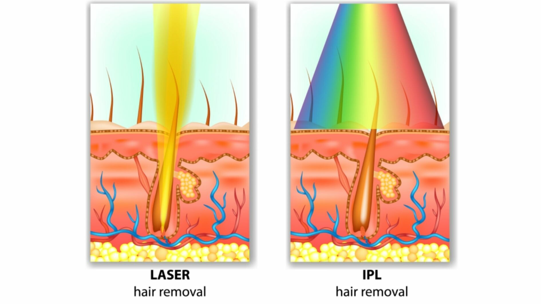 IPL home devices vs laser hair removal - London Premier Laser & Skin Clinic