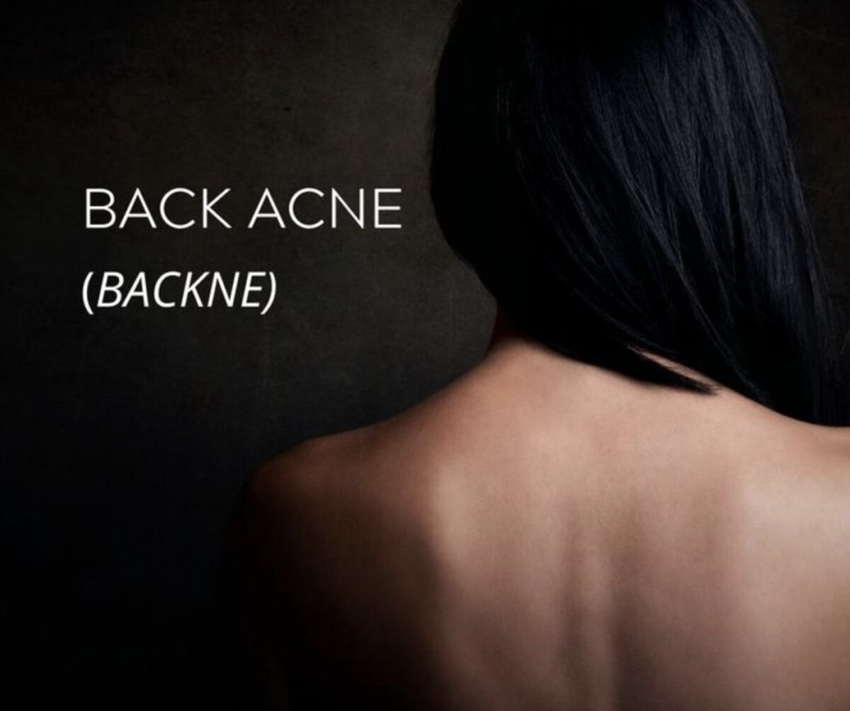 3 Top treatments for back acne (backne)
