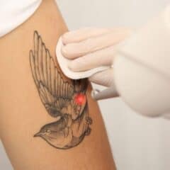 Patient receiving laser tattoo removal treatment on arm