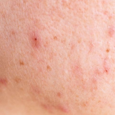 Woman with visible acne scars on her face