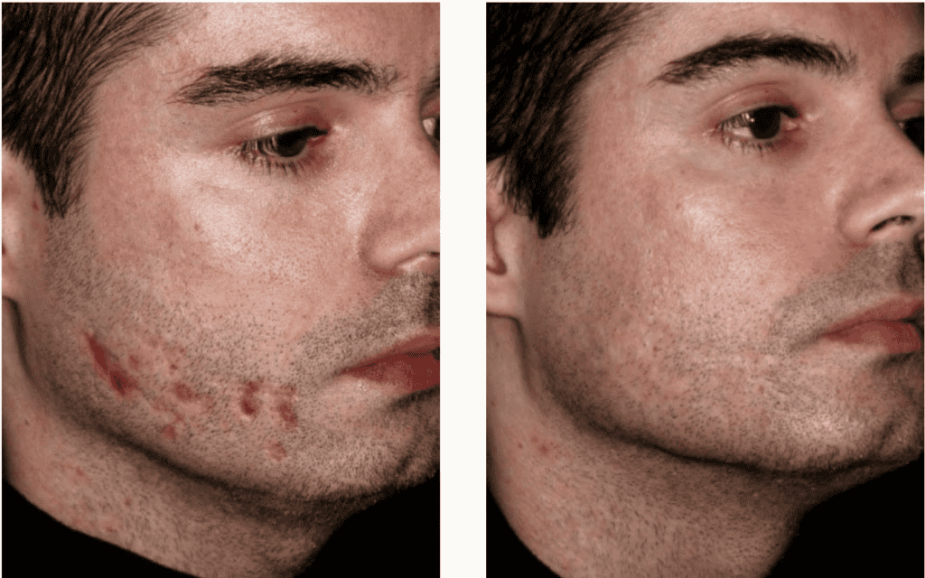 Scar Removal Treatments before and after