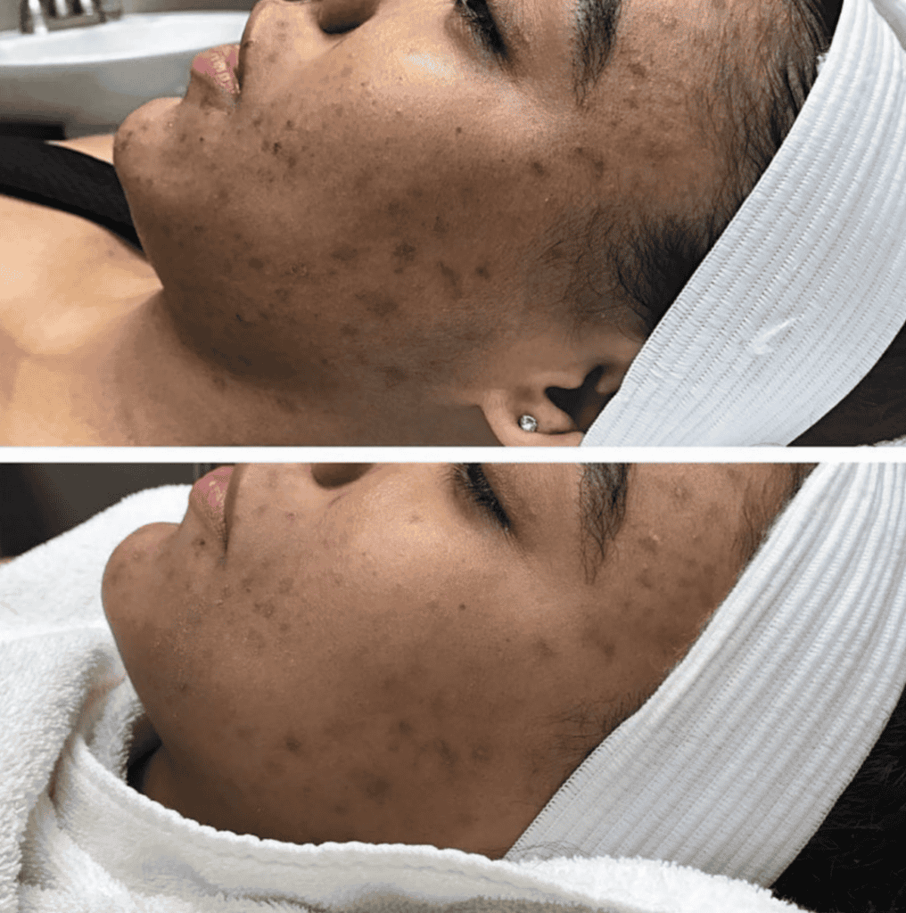 Acne before and after