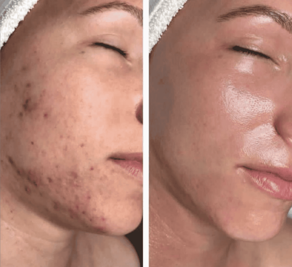 Acne before and after