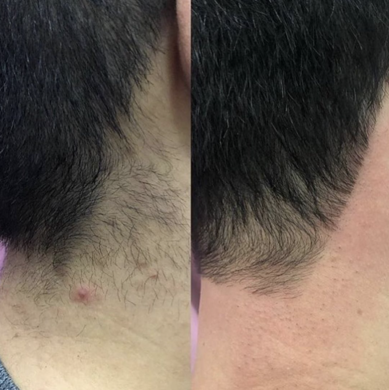 Laser Hair Removal For Men | London Premier Laser Clinic