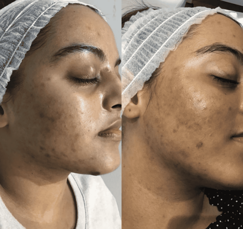 Acne before and after
