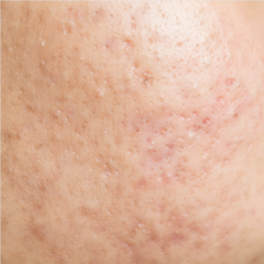 Acne Scar Removal and Treatment