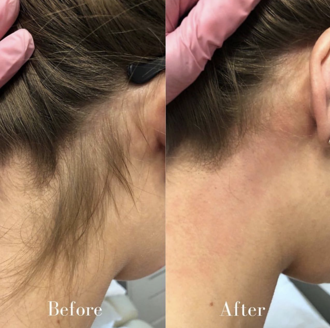 laser hair removal before & after