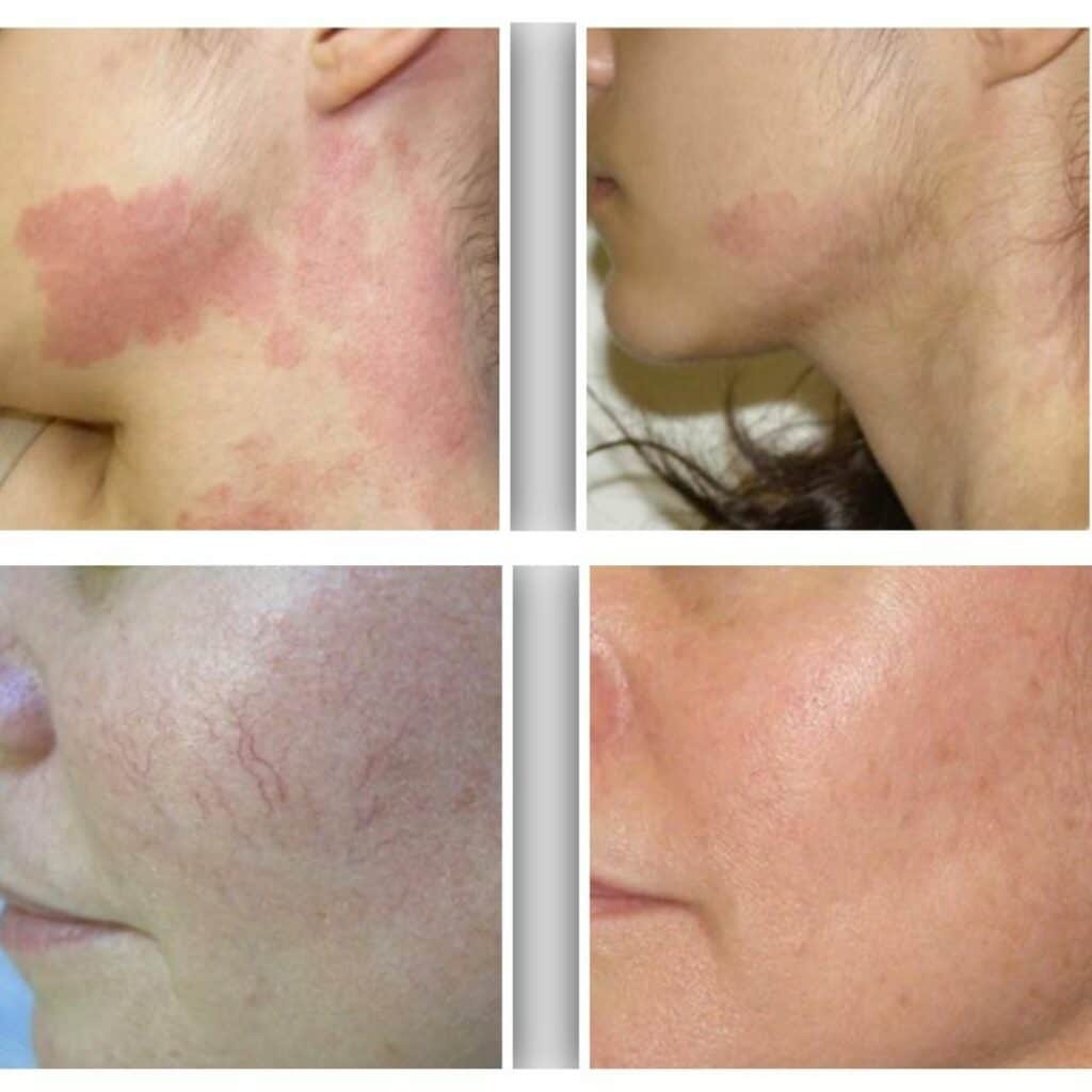 Rosacea Treatment before and after