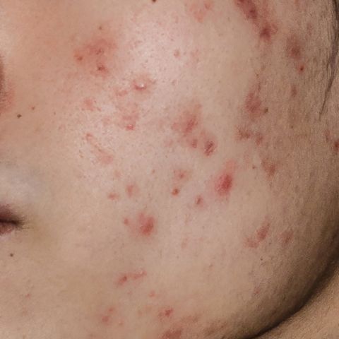 Close-up of woman with moderate to severe facial acne