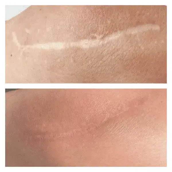 Scar Removal Treatments before and after