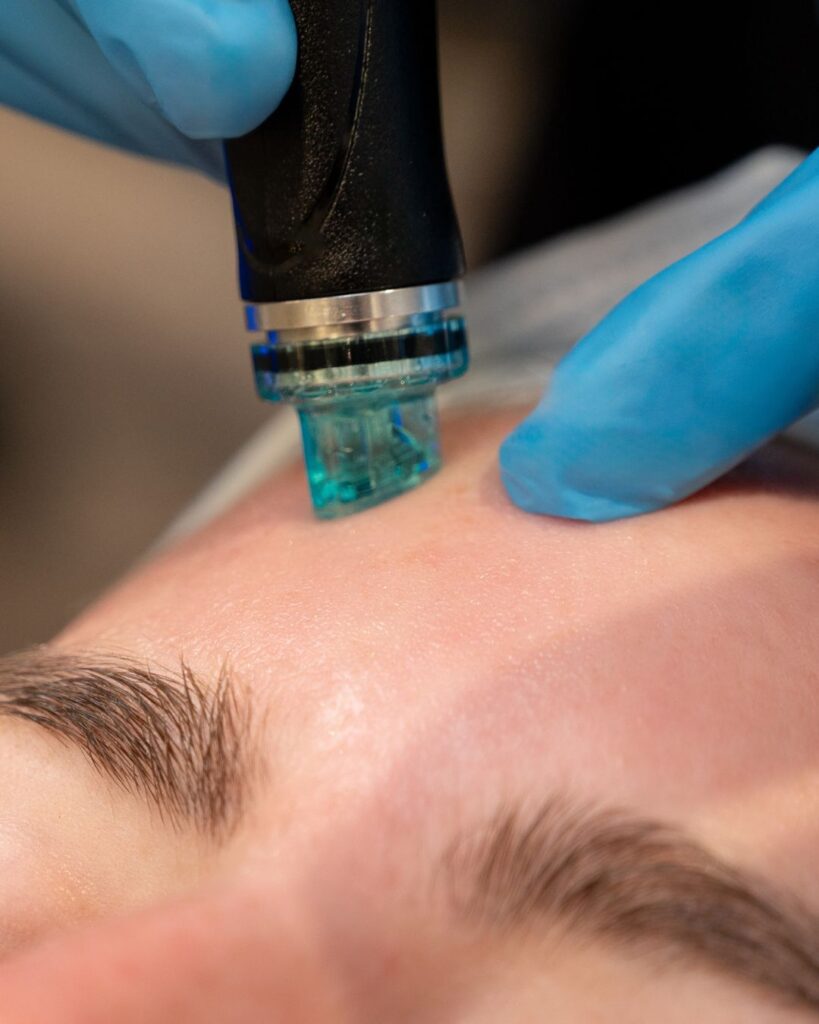 Hydrafacial Treatment