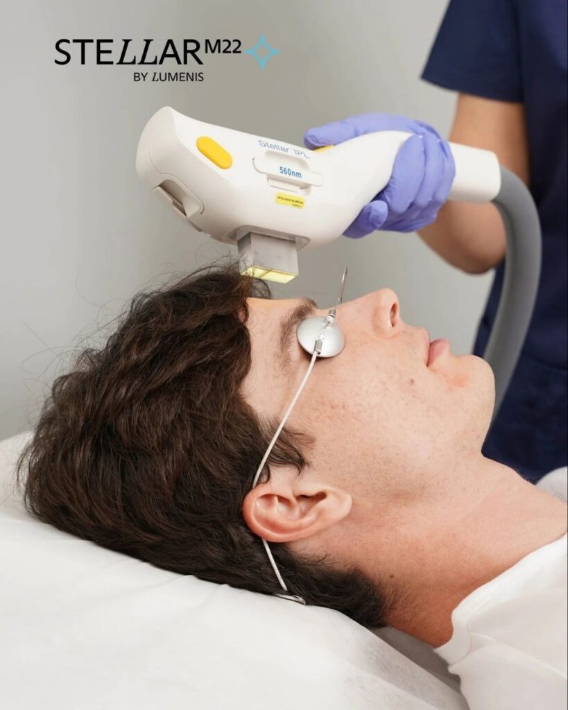 Stellar M22 IPL Skin Rejuvenation