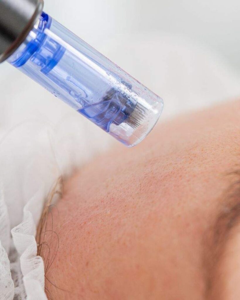 Dermapen Microneedling Treatment