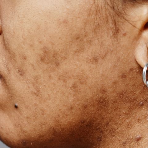 Woman with visible pigmentation on the side of her face