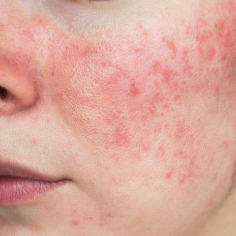Woman with visible rosacea on cheeks
