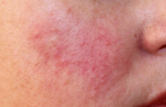 Rosacea &#038; Skin Redness Treatments: London &#038; Surrey