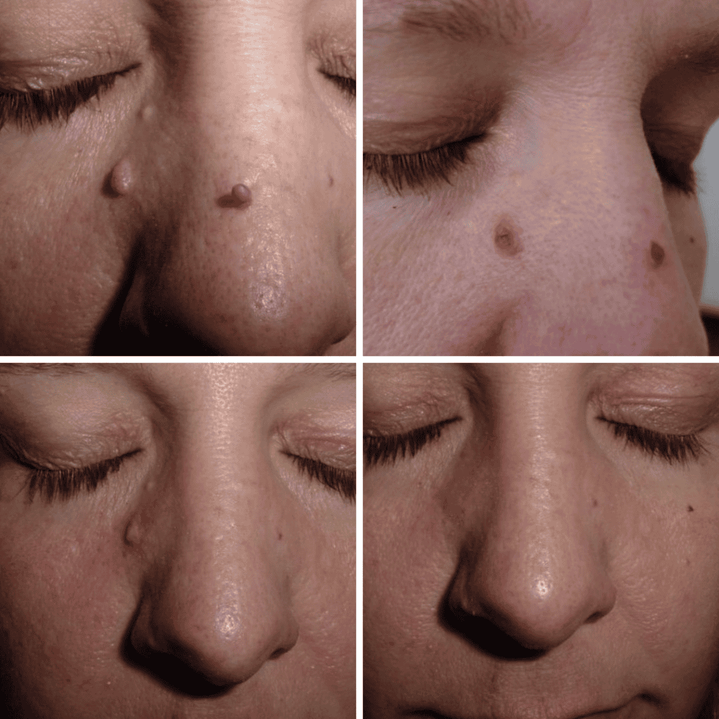Skin Tag Removal before and after