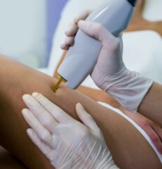 Laser hair removal with laser in London