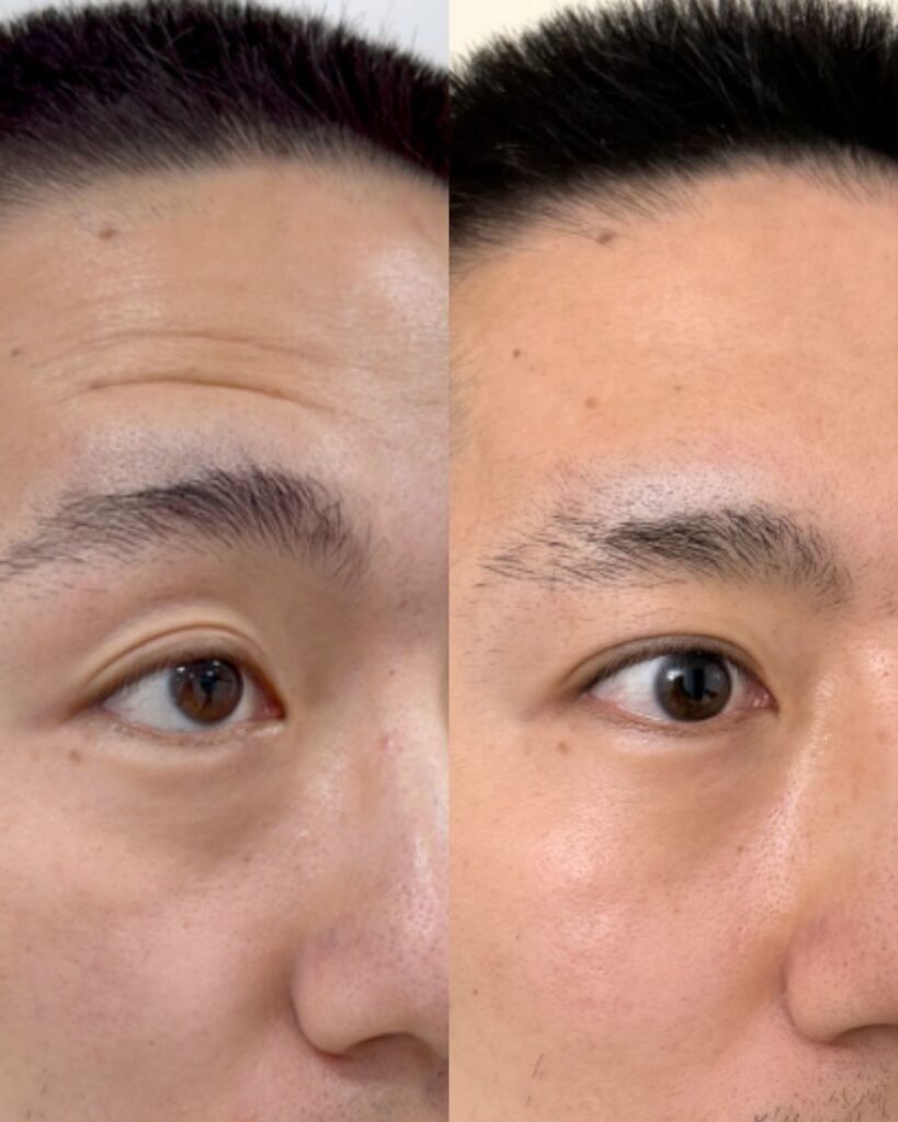 Anti-Wrinkle Injections before and after