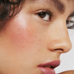 laser hair removal PCOS