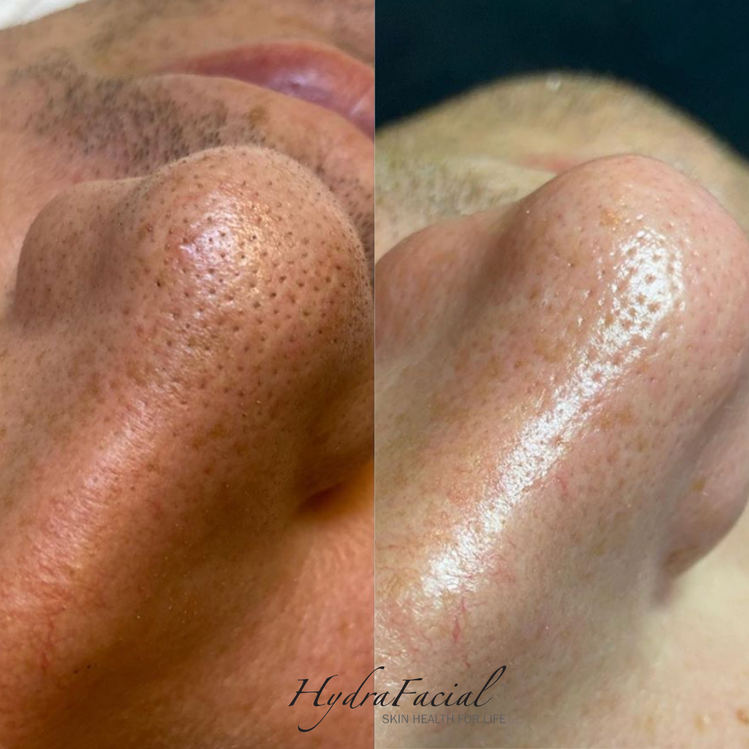 Hydrafacial Before and After Photos