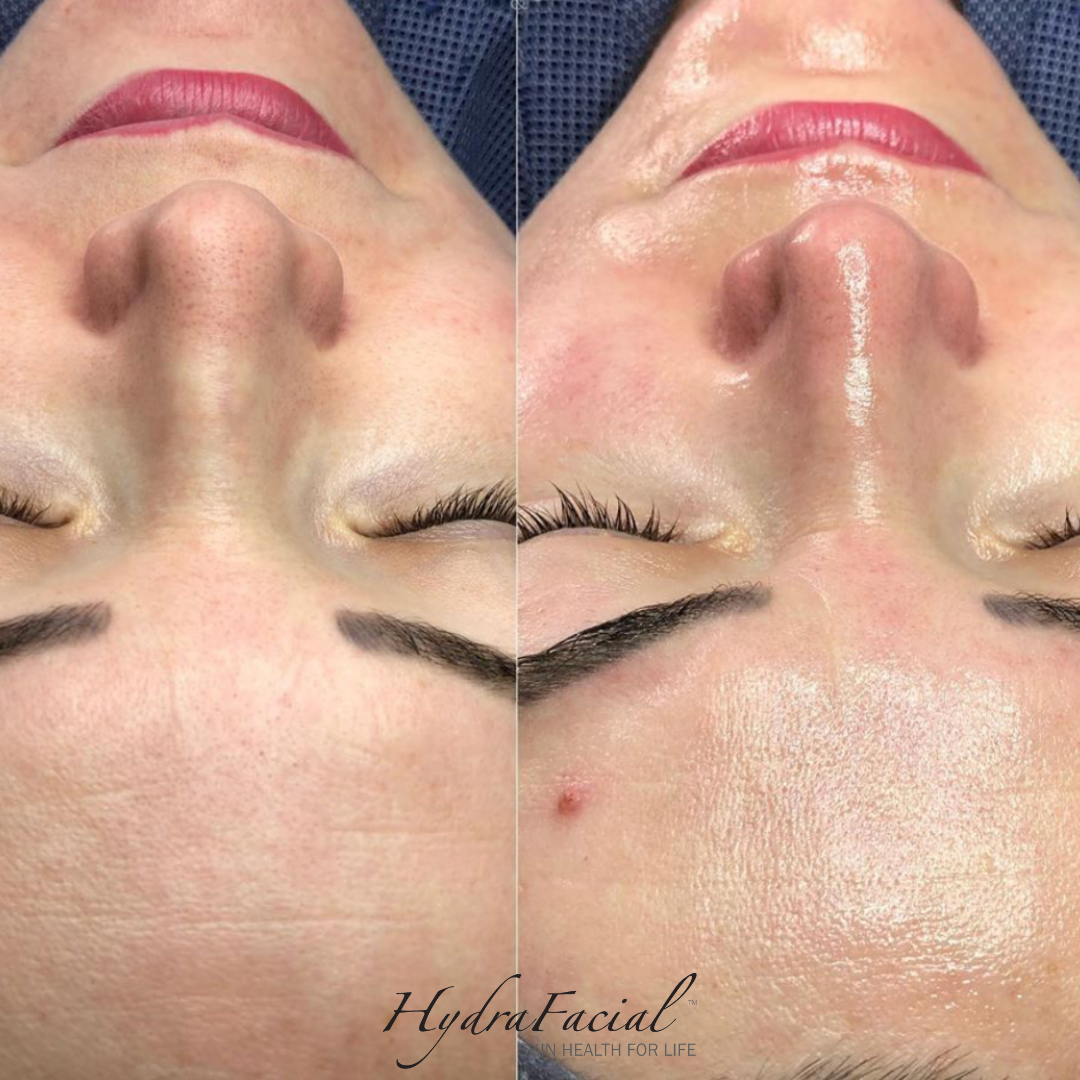 Hydrafacial Before and After Photos