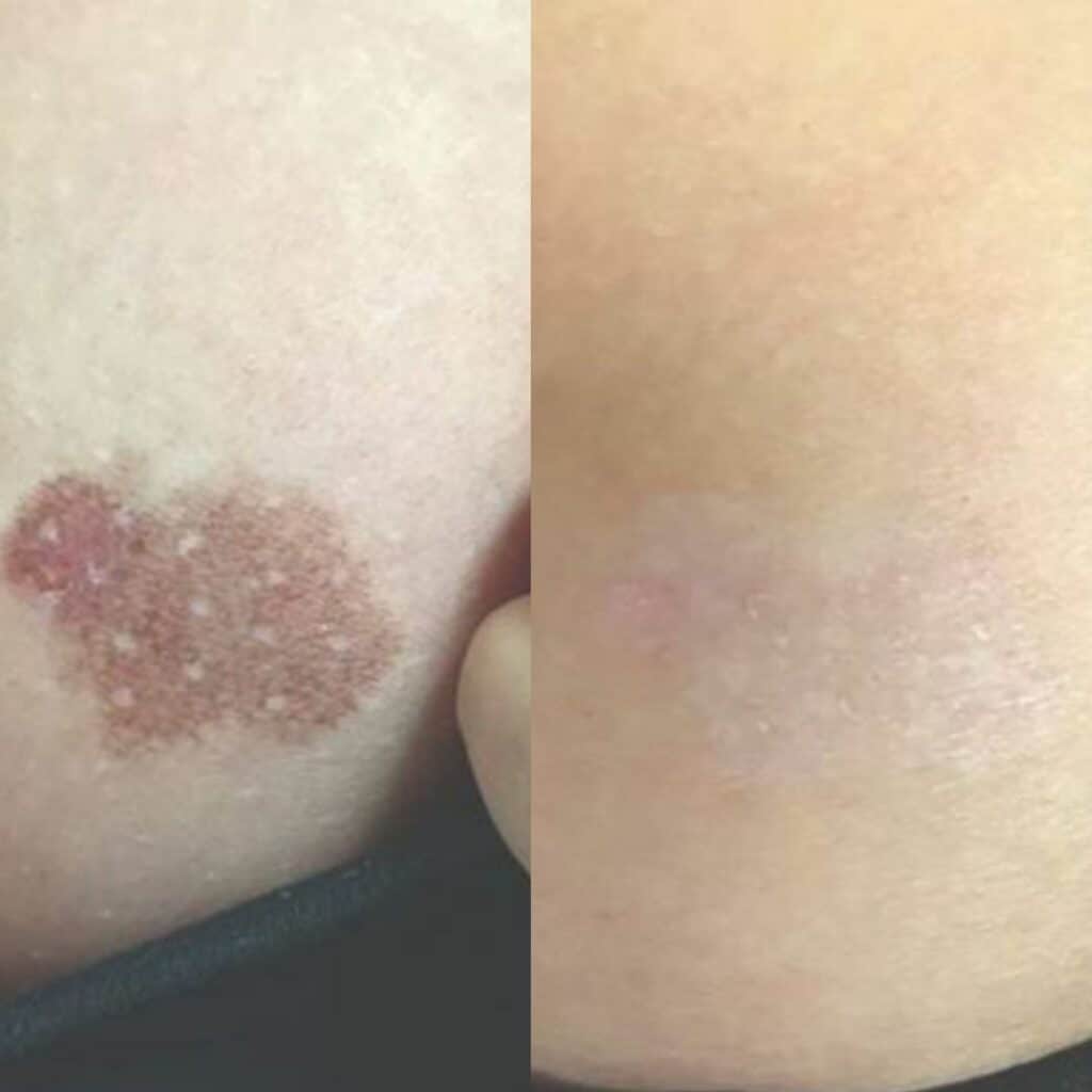 Skin Pigmentation Treatment before and after
