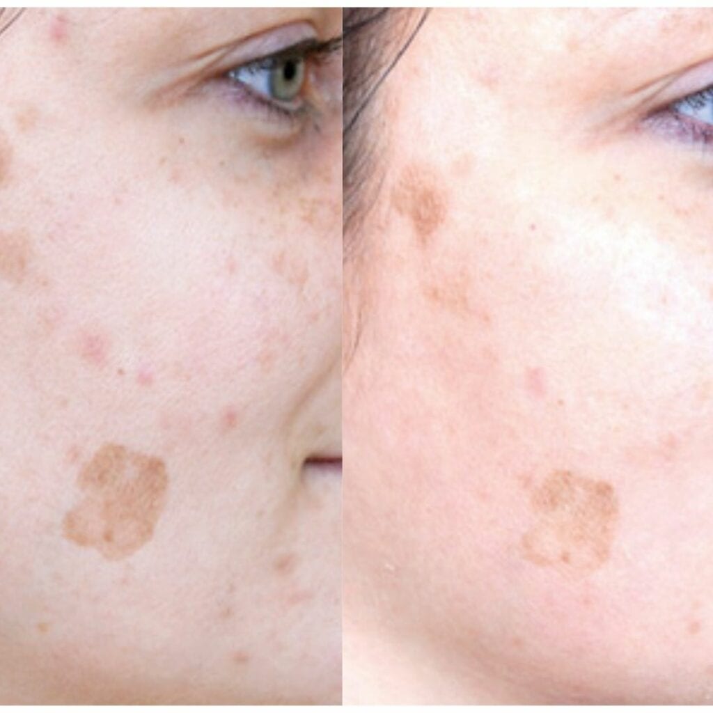 Skin Pigmentation Treatment before and after
