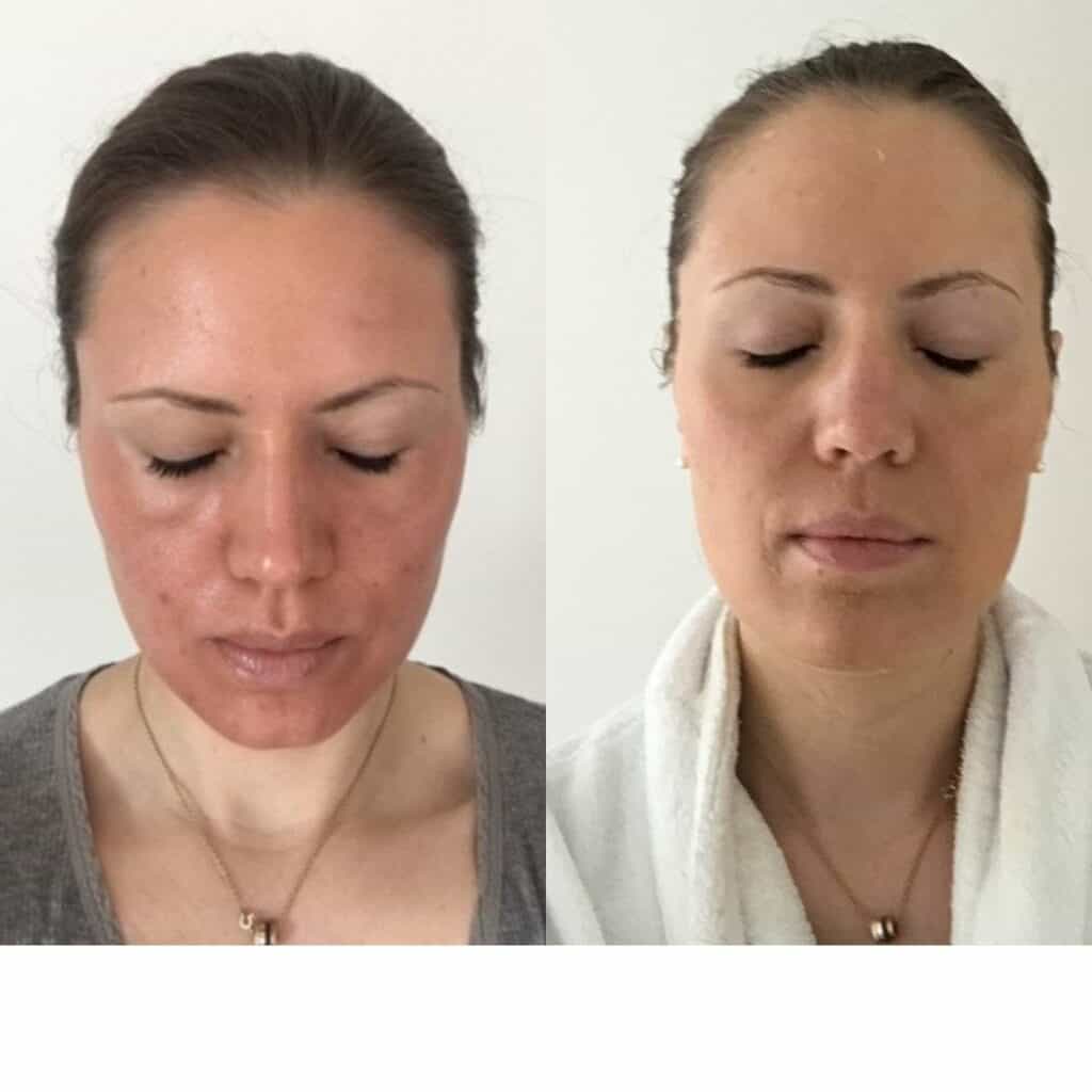 Before and after