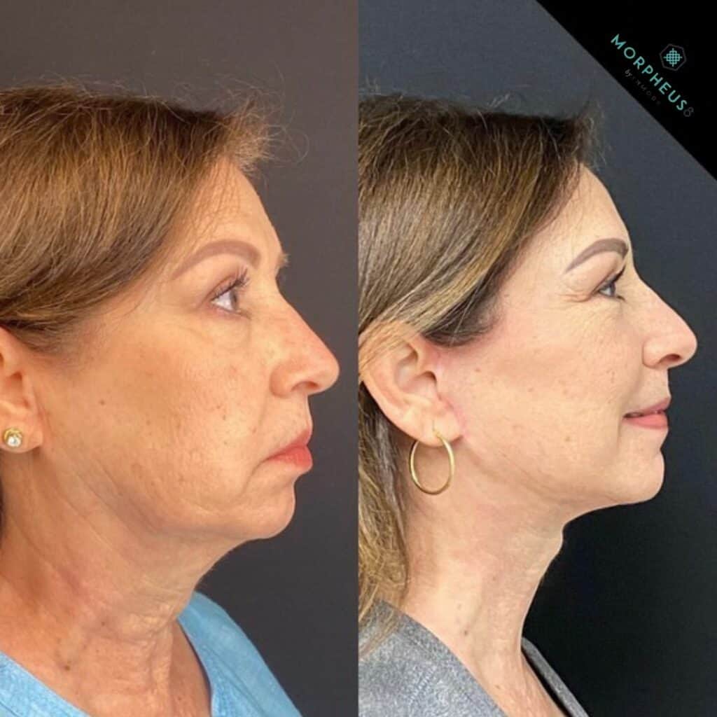 Skin Tightening Treatments before and after