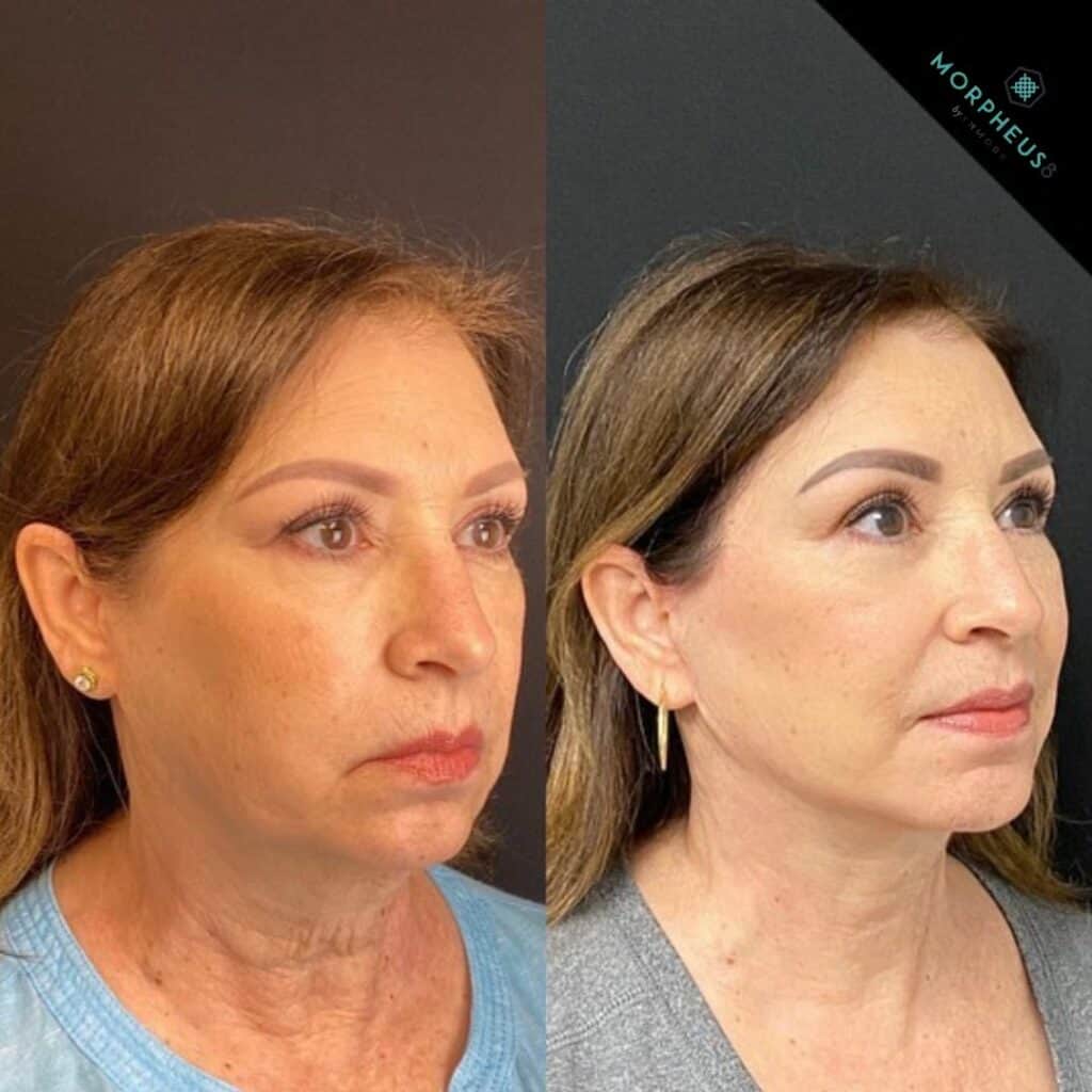 Skin Tightening Treatments before and after