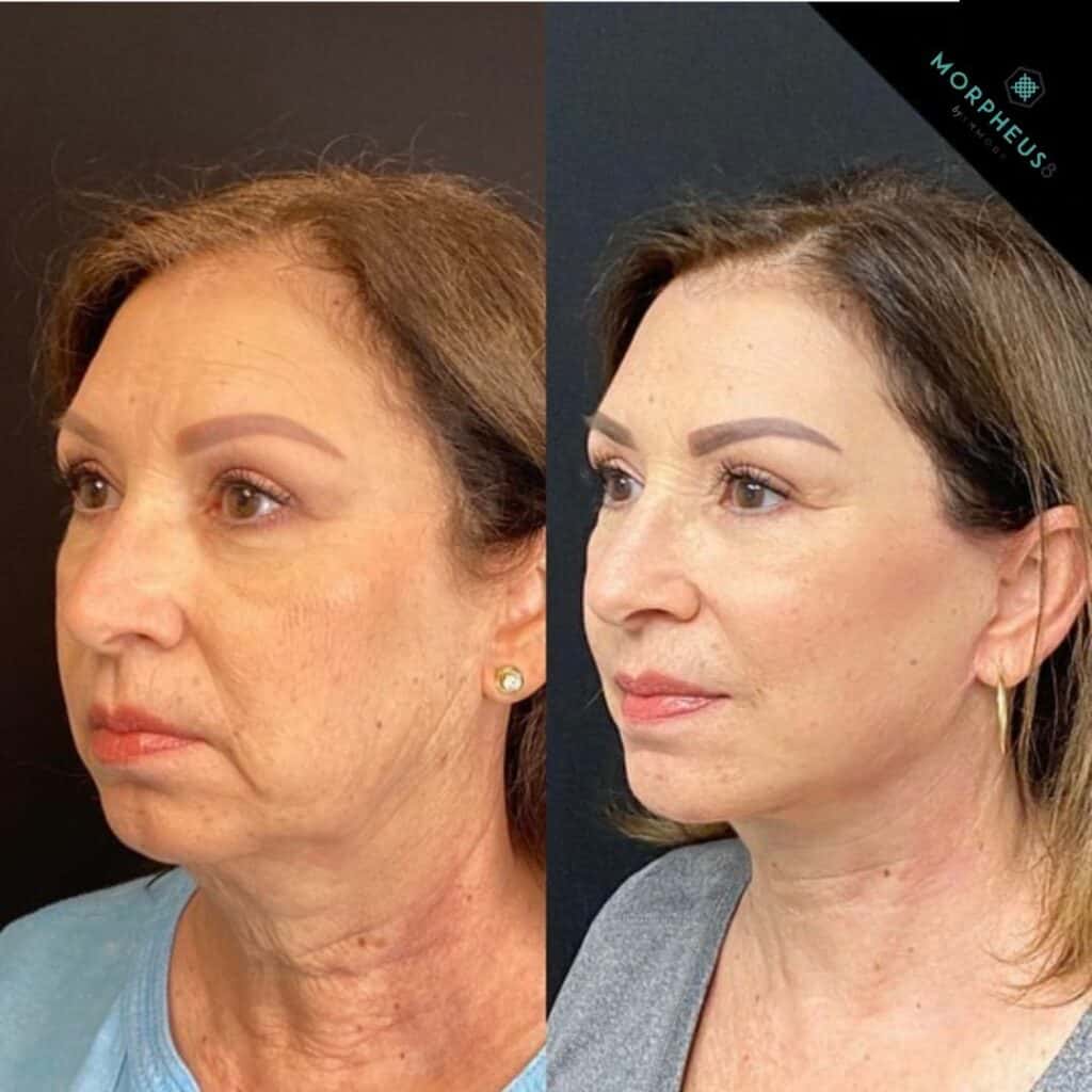 Skin Tightening Treatments before and after