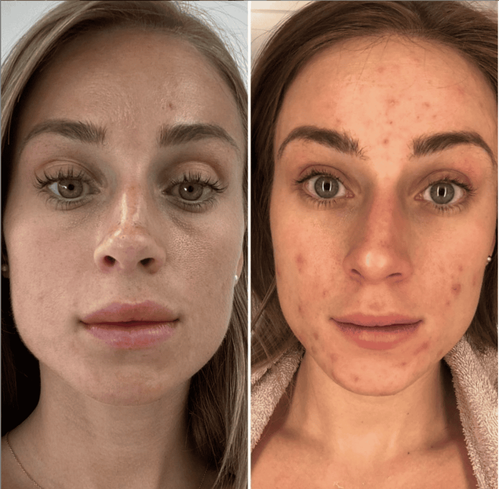 Skin Pigmentation Treatment before and after