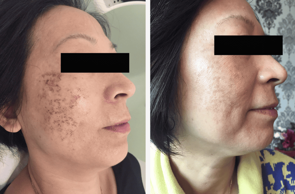 Skin Pigmentation Treatment before and after