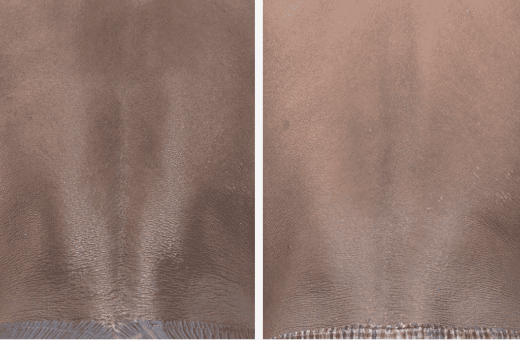 Skin Pigmentation Treatment before and after