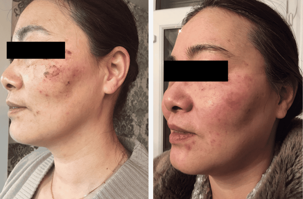 Skin Pigmentation Treatment before and after