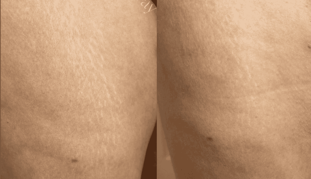 Stretch Mark Removal before and after