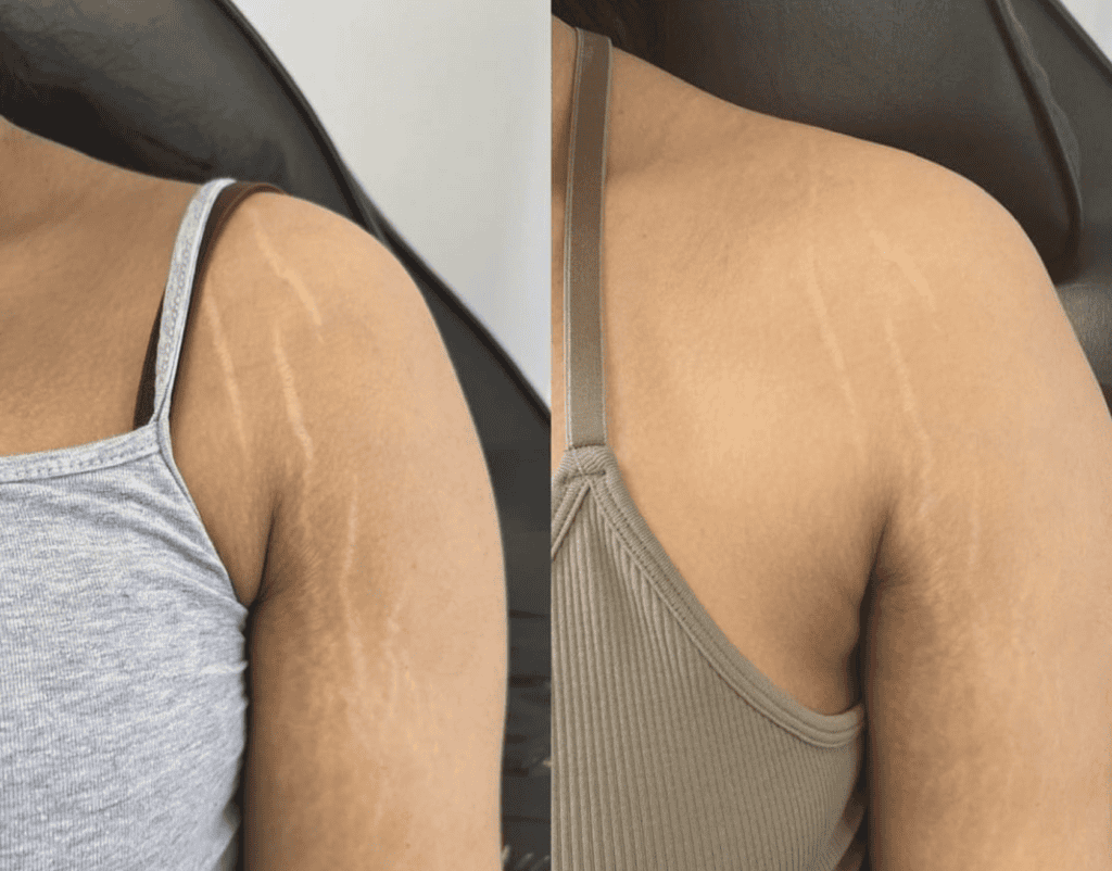 Stretch Mark Removal before and after