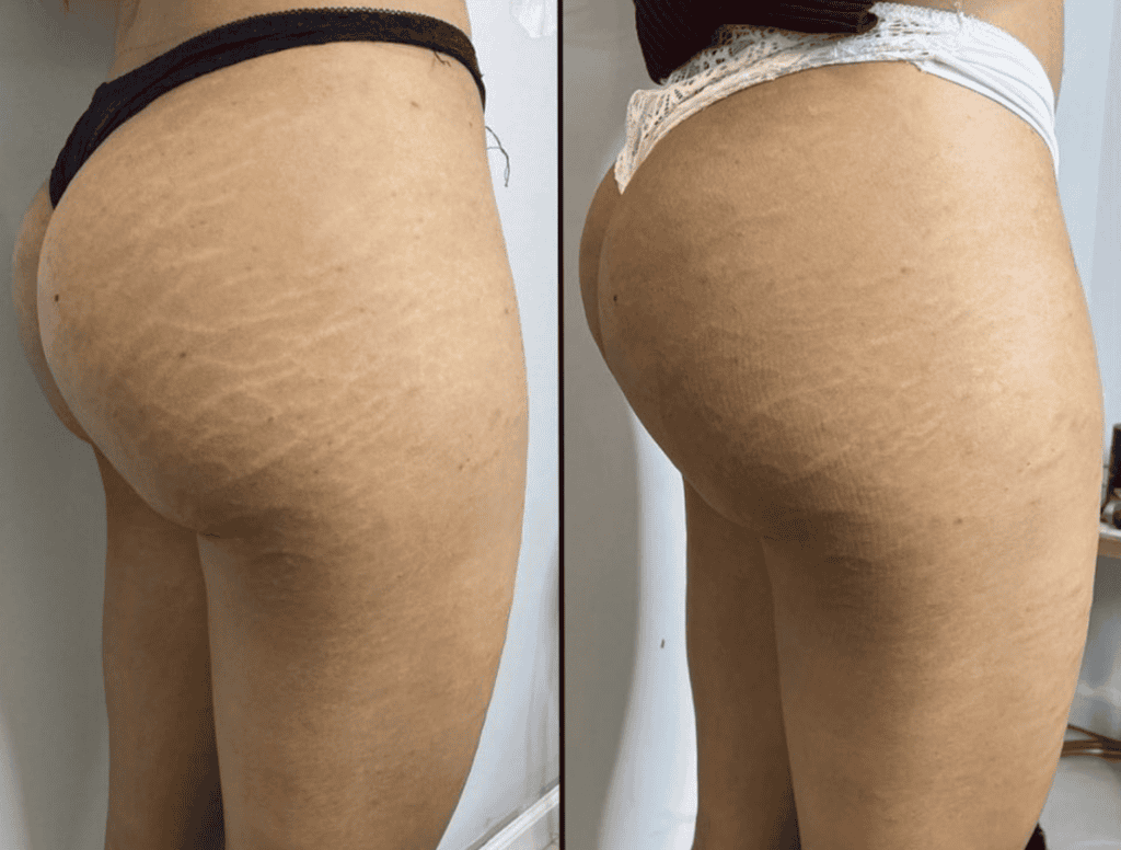 Stretch Mark Removal before and after