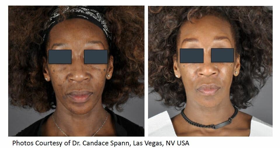 Skin Pigmentation Treatment before and after