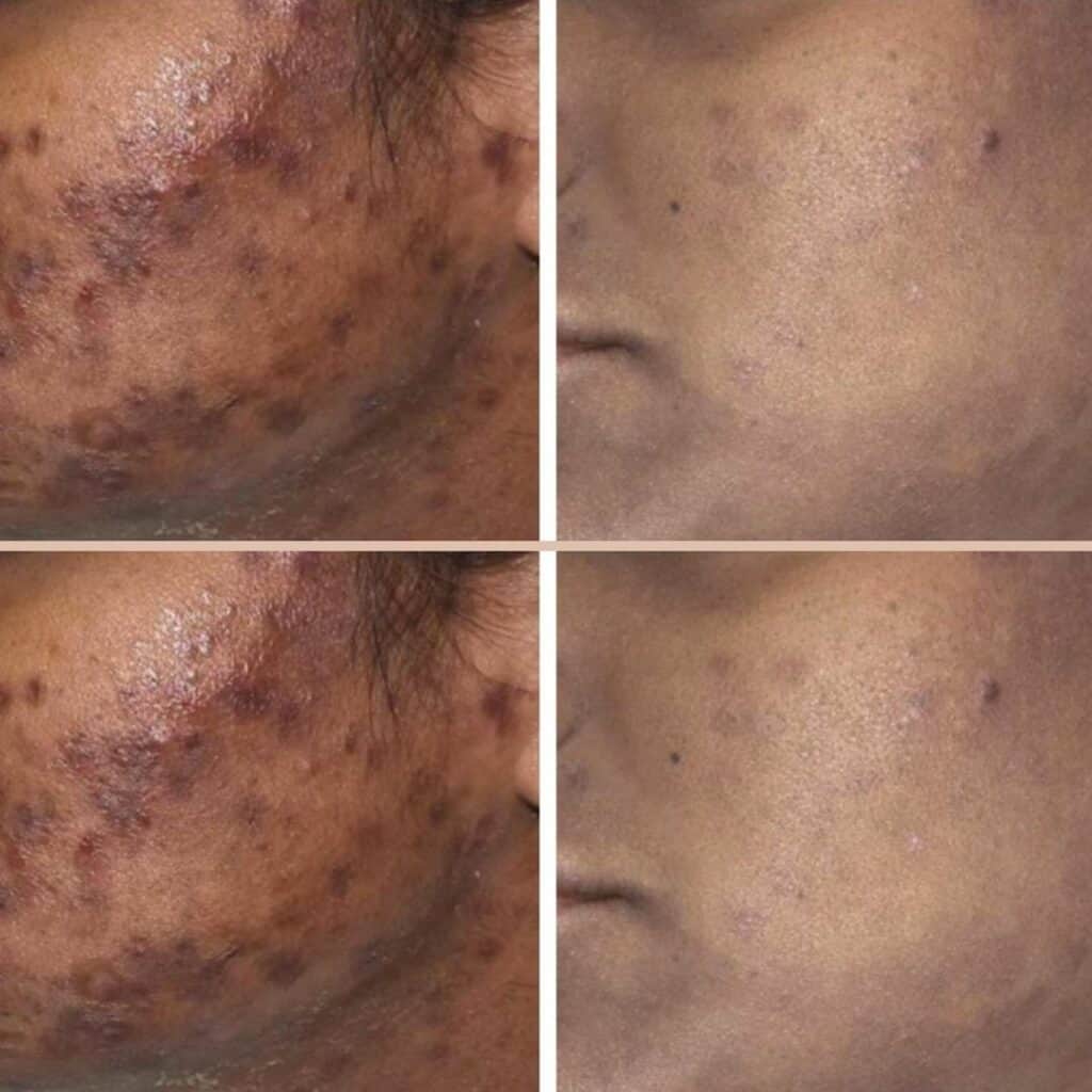Acne before and after