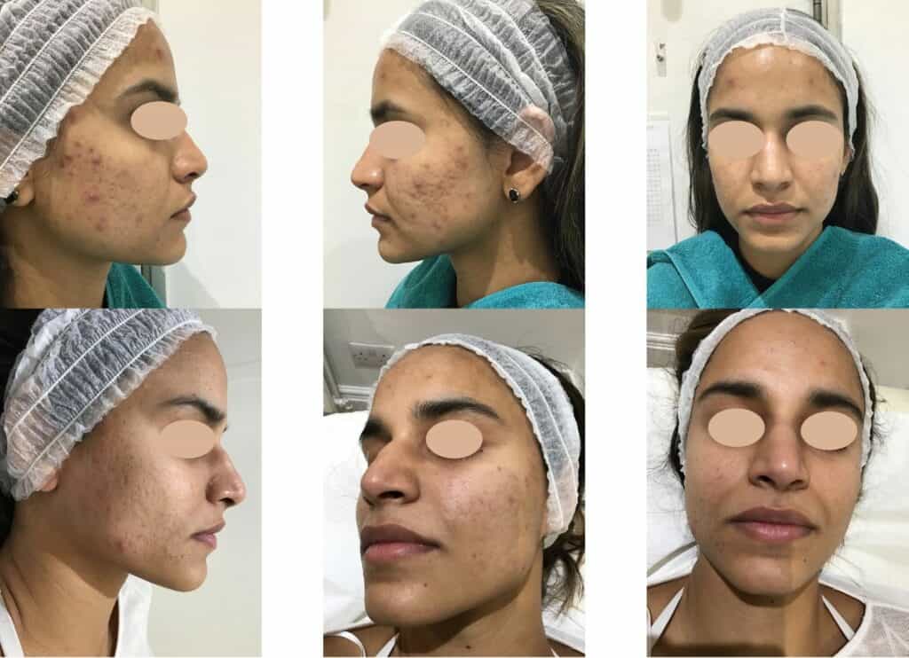Acne before and after