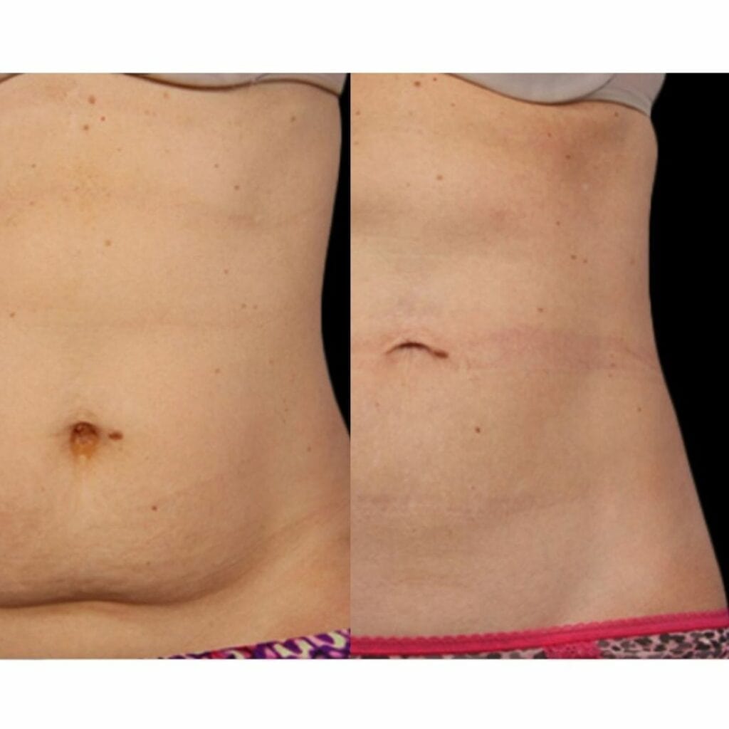 Before and after