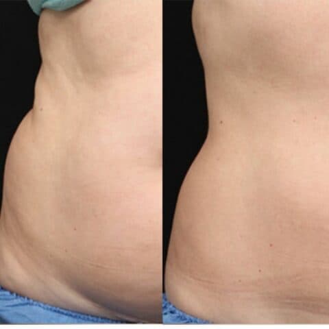 love handles coolsculpting