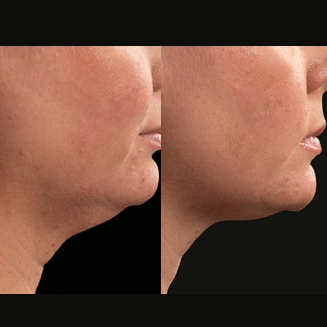 Top 3 Double Chin Reduction Treatments