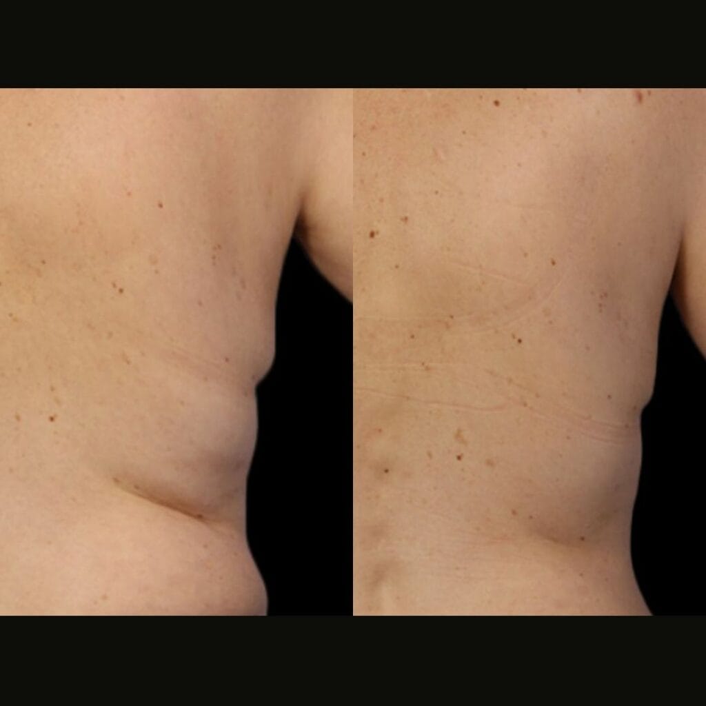 Fat Reduction Treatments before and after